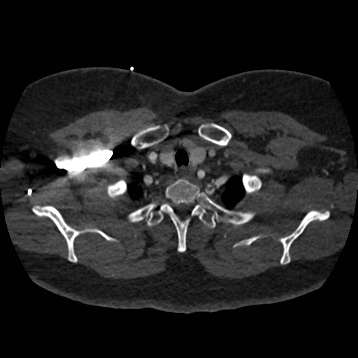 Aortic dissection (Radiopaedia 57969-64959 A 39).jpg