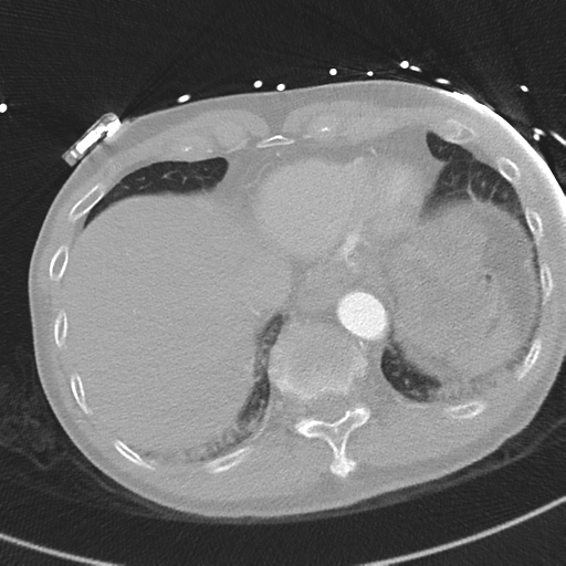 File:Aortic dissection - DeBakey type II (Radiopaedia 64302-73082 Axial lung window 53).png