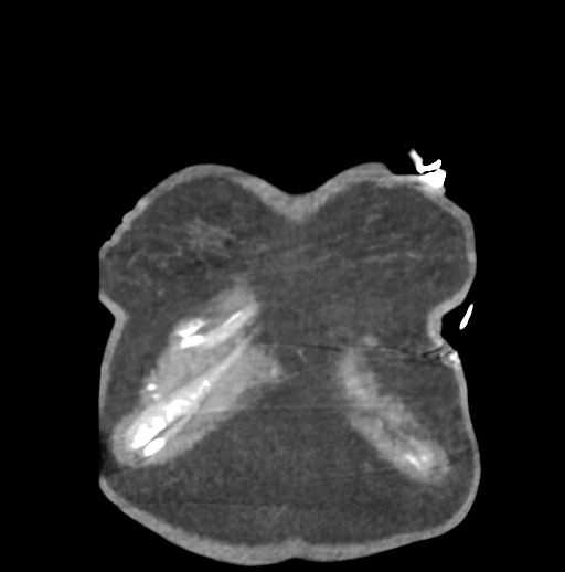 File:Aortic dissection - Stanford type B (Radiopaedia 50171-55512 B 7).png