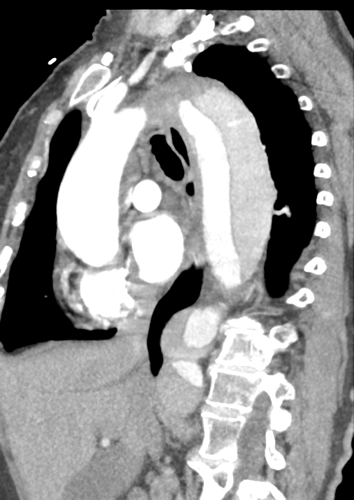 Aortic dissection - Stanford type B (Radiopaedia 50171-55512 C 32).png
