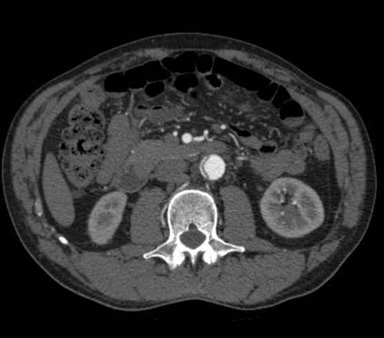 Aortic dissection - Stanford type B (Radiopaedia 73648-84437 A 156).jpg