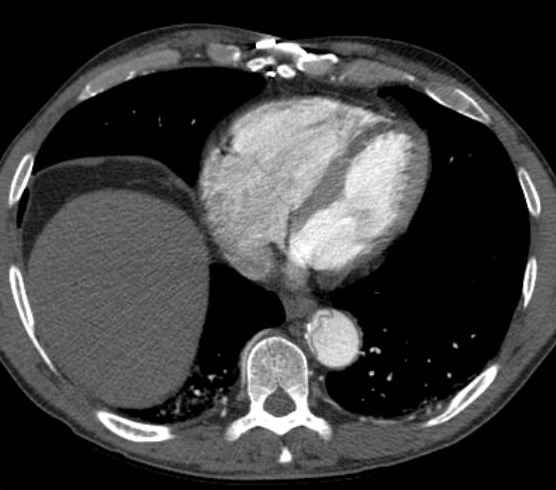 Aortic dissection - Stanford type B (Radiopaedia 73648-84437 A 83).jpg