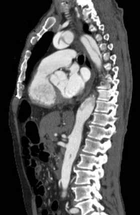 File:Aortic dissection - Stanford type B (Radiopaedia 73648-84437 C 69).jpg