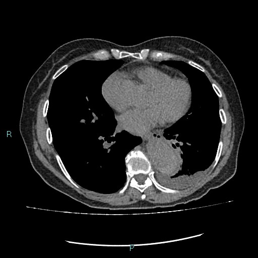 File:Aortic dissection extended to lusory artery (Radiopaedia 43686-47136 Axial non-contrast 18).jpg