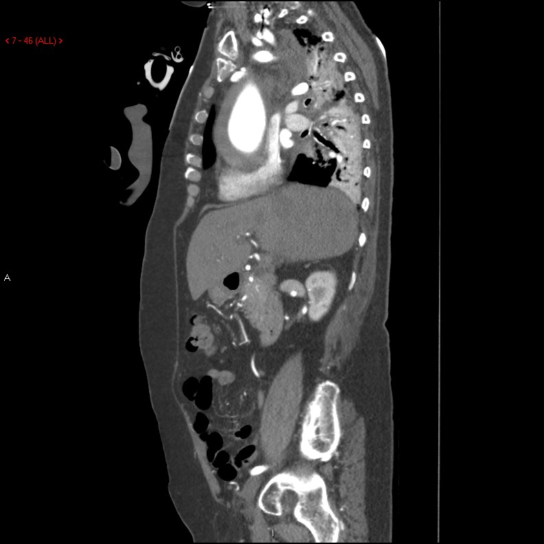 Aortic intramural hematoma (Radiopaedia 27746-28001 C 15).jpg