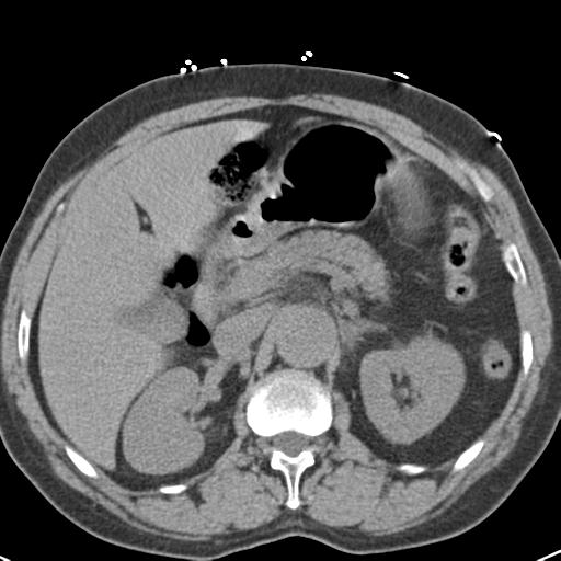 File:Aortic intramural hematoma (Radiopaedia 31139-31838 Axial non-contrast 56).jpg