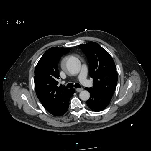 Aortic intramural hematoma (Radiopaedia 48463-53380 C 65).jpg