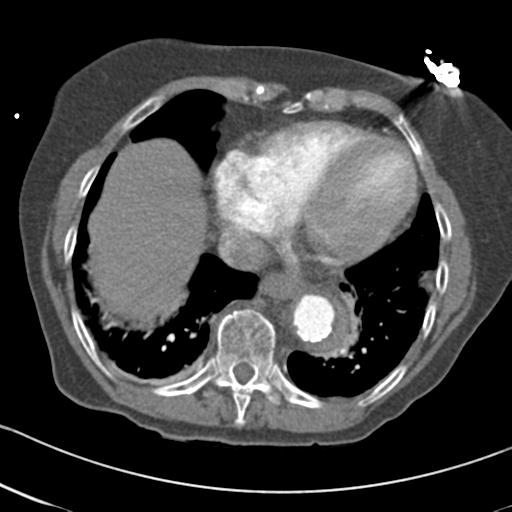 File:Aortic intramural hematoma from penetrating atherosclerotic ulcer (Radiopaedia 31137-31836 A 60).jpg