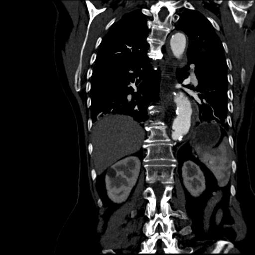 Aortic intramural hematoma from penetrating atherosclerotic ulcer (Radiopaedia 31137-31836 C 46).jpg