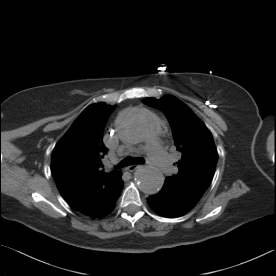 File:Aortic intramural hematoma with dissection and intramural blood pool (Radiopaedia 77373-89491 Axial non-contrast 36).jpg