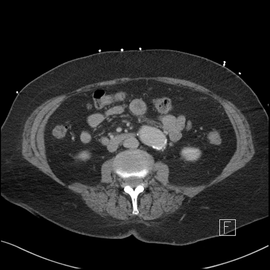 File:Aortic intramural hematoma with dissection and intramural blood pool (Radiopaedia 77373-89491 E 41).jpg