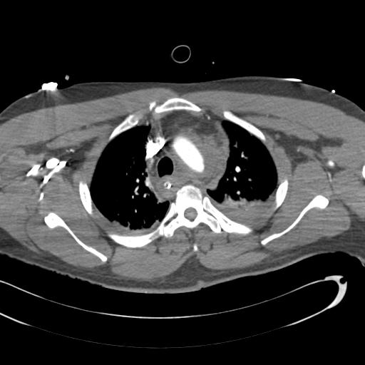 Aortic transection, diaphragmatic rupture and hemoperitoneum in a complex multitrauma patient (Radiopaedia 31701-32622 A 26).jpg