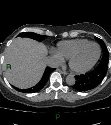 File:Aortic valve endocarditis (Radiopaedia 87209-103485 Axial non-contrast 77).jpg