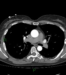 Aortic valve endocarditis (Radiopaedia 87209-103485 C 41).jpg