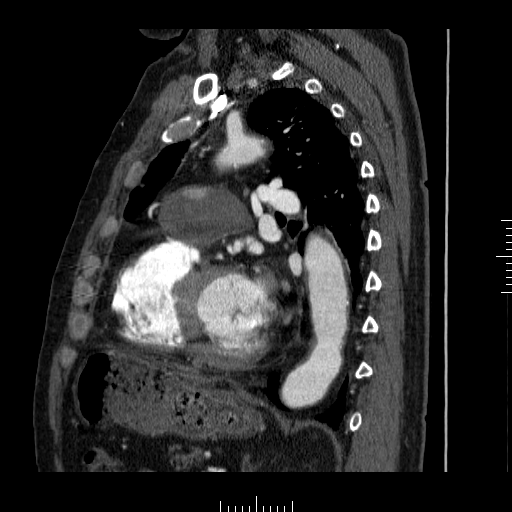 File:Aorto-coronary bypass graft aneurysms (Radiopaedia 40562-43157 C 26).png