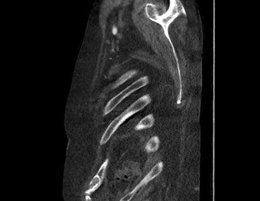 File:Aortoesophageal fistula with endovascular repair (Radiopaedia 73781-84592 Sagittal C+ CTPA 186).jpg