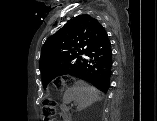 Aortoesophageal fistula with endovascular repair (Radiopaedia 73781-84592 Sagittal C+ CTPA 66).jpg