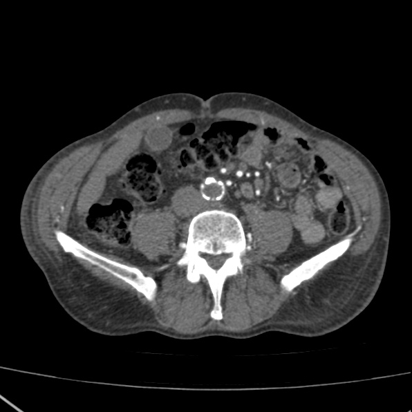 Aortoiliac occlusive disease (Radiopaedia 32134-33076 G 49).jpg