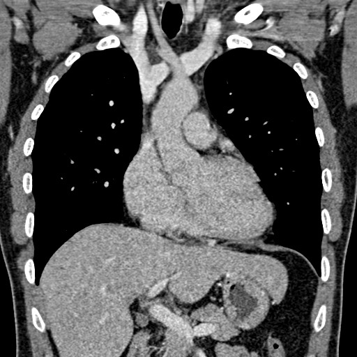 Apical lung mass mimic - neurogenic tumor (Radiopaedia 59918-67521 B 54).jpg