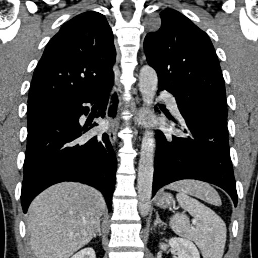 Apical lung mass mimic - neurogenic tumor (Radiopaedia 59918-67521 B 72).jpg