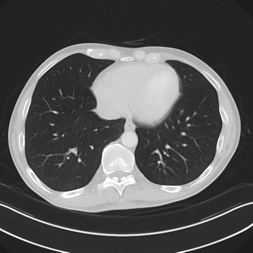 Apical pleural calcification (Radiopaedia 46141-50499 Axial lung window 52).png