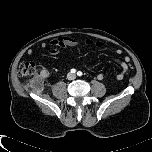 File:Appendiceal adenocarcinoma complicated by retroperitoneal abscess (Radiopaedia 58007-65039 B 87).jpg