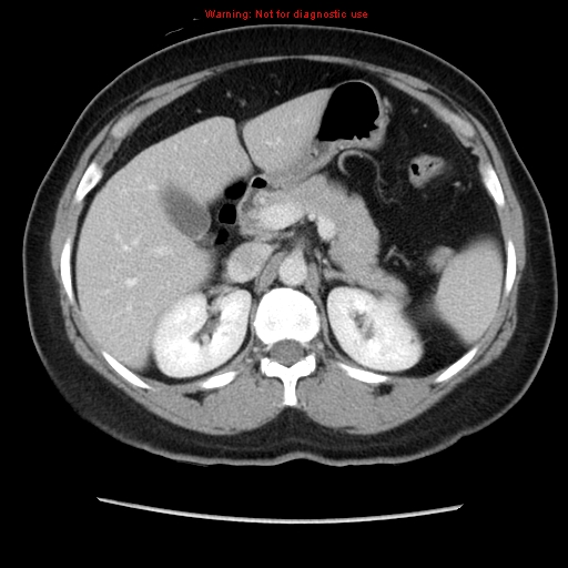 File:Appendiceal mucinous cystadenoma (Radiopaedia 8263-9111 Axial liver window 28).jpg
