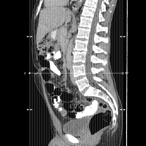 Appendicitis complicated by post-operative collection (Radiopaedia 35595-37113 B 1).jpg