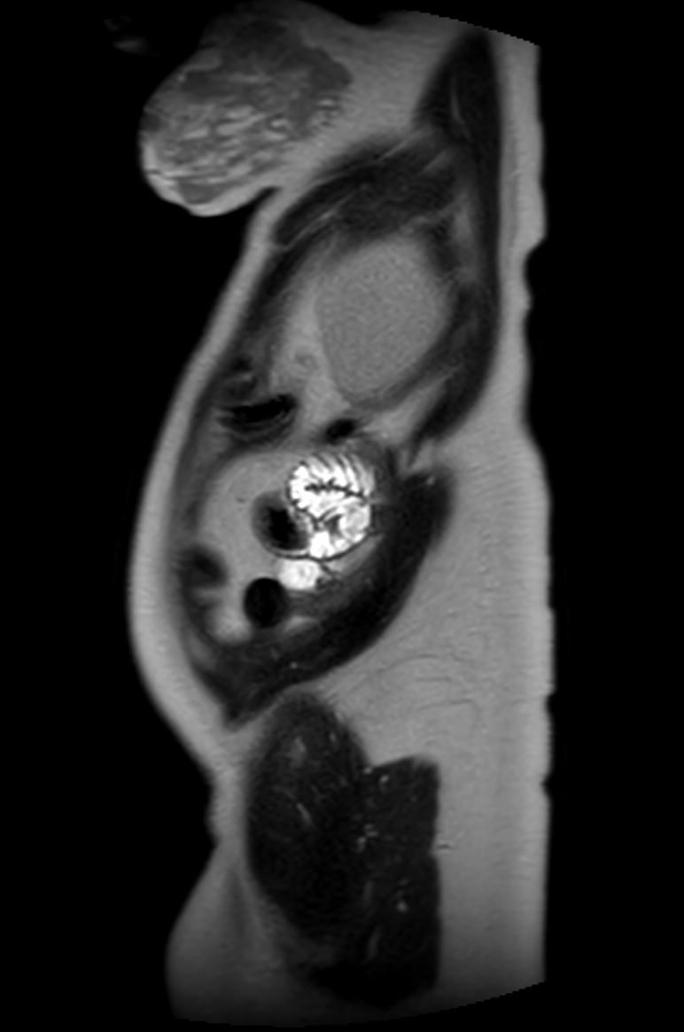 Appendicitis in gravida (MRI) (Radiopaedia 89433-106395 Sagittal T2 7).jpg