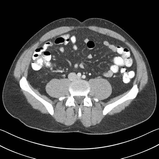 File:Appendicitis with cecal bar sign (Radiopaedia 31878-32830 B 50).jpg