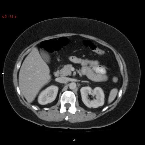Appendicitis with microperforation- promontoric type (Radiopaedia 27268-27442 C 19).jpg