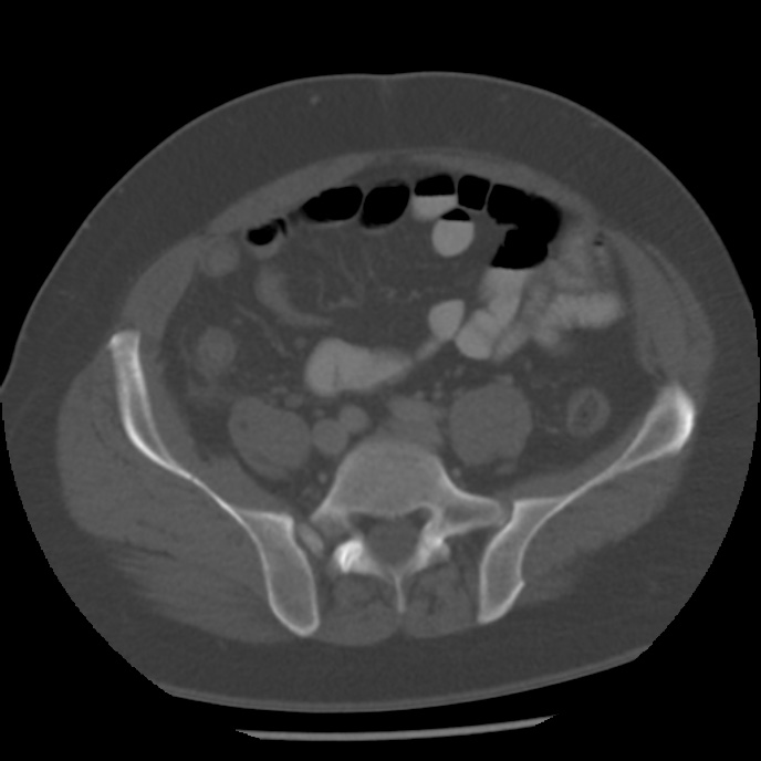 Appendicitis with perforation (Radiopaedia 35790-37342 Axial bone window 37).jpg