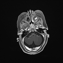 Aqueductal stenosis (Radiopaedia 73974-84802 Axial T1 C+ 48).jpg