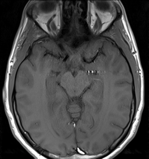 File:Arachnoid cyst - cerebellopontine angle (Radiopaedia 59689-67083 Axial T1 20).png