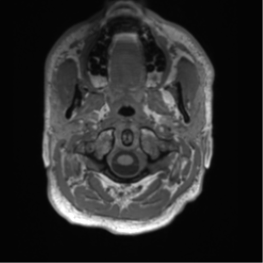 File:Arachnoid cyst with subdural hematoma (Radiopaedia 85892-101743 Axial T1 4).png