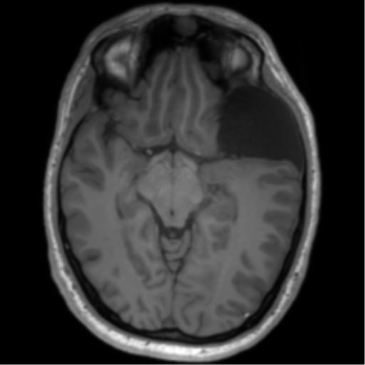 File:Arachnoid cyst with subdural hematoma (Radiopaedia 85892-101743 Axial T1 40).png