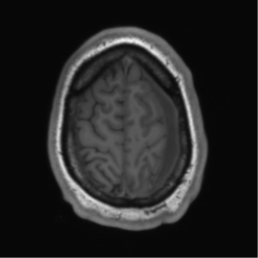 File:Arachnoid cyst with subdural hematoma (Radiopaedia 85892-101743 Axial T1 73).png