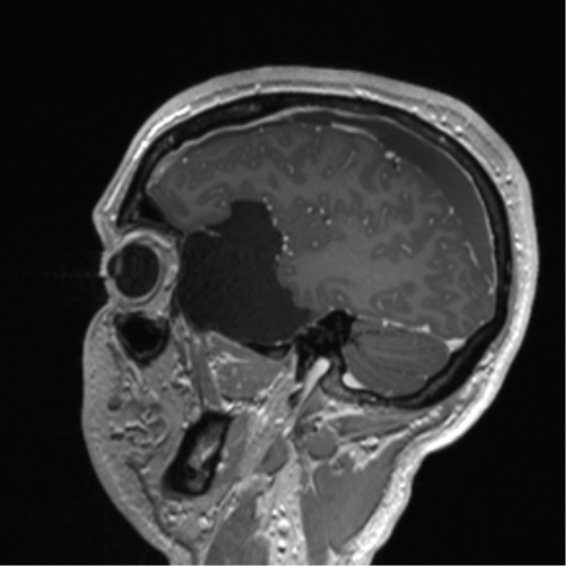 Arachnoid cyst with subdural hematoma (Radiopaedia 85892-101743 Sagittal T1 C+ 27).png