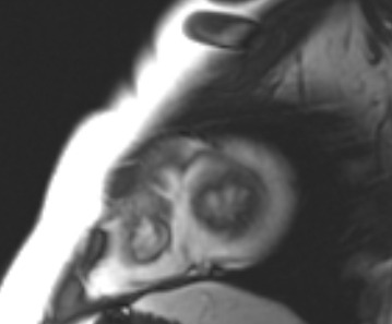 File:Arrhythmogenic right ventricular cardiomyopathy (Radiopaedia 69431-79307 Short axis cine 2).jpg