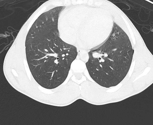 Arrow injury to the chest (Radiopaedia 75223-86321 Axial lung window 56).jpg