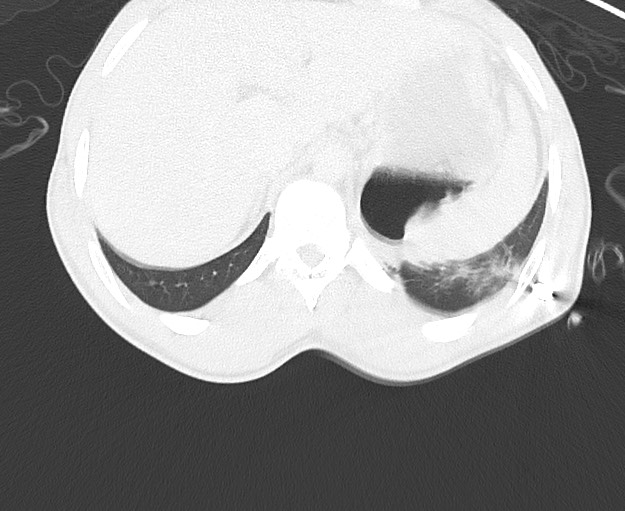 File:Arrow injury to the chest (Radiopaedia 75223-86321 Axial lung window 96).jpg