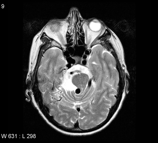 File:Arteriovenous malformation - cerebral (Radiopaedia 4000-6538 Axial T2 3).jpg
