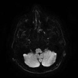 File:Artery of Percheron infarct (Radiopaedia 48088-52928 Axial DWI 7).jpg