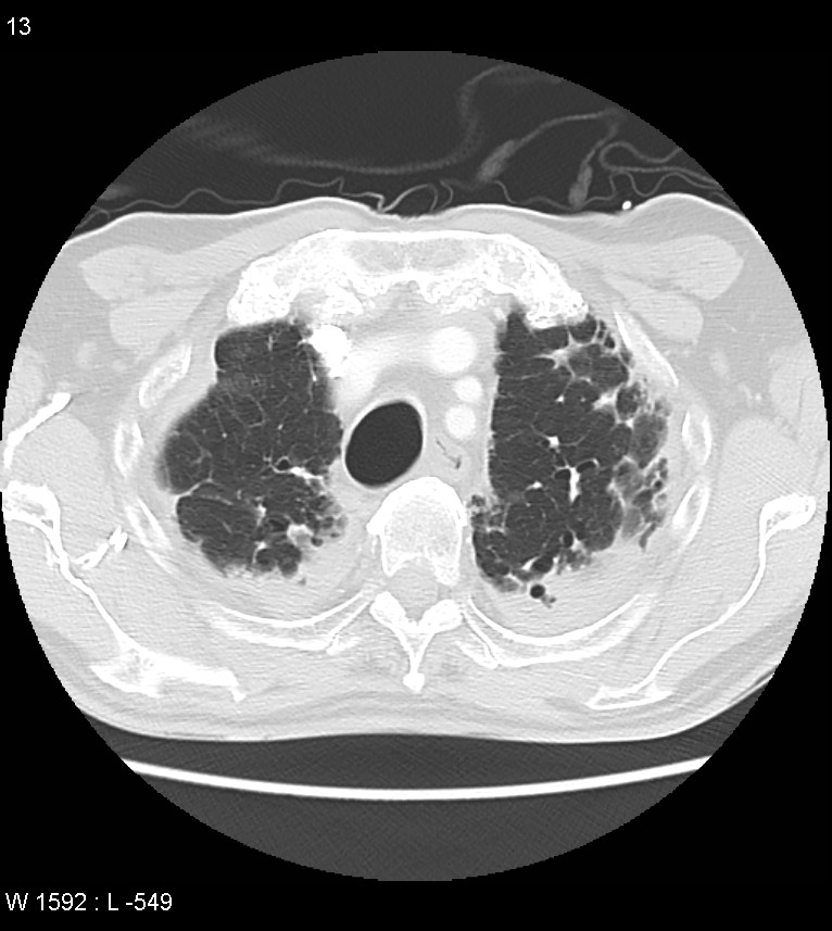 Asbestos related lung and pleural disease (Radiopaedia 14377-14301 A 10).jpg