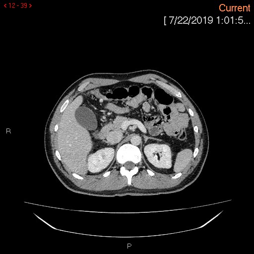 File:Ascending colonic diverticulum mimicking acute appendicitis (Radiopaedia 69943-80198 A 39).jpg