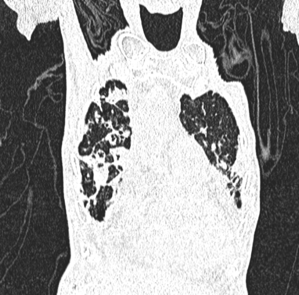 File:Aspergilloma- with Monod sign (Radiopaedia 44737-48532 Coronal lung window 149).jpg