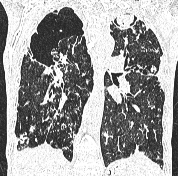 Aspergilloma- with Monod sign (Radiopaedia 44737-48532 Coronal lung window 289).jpg