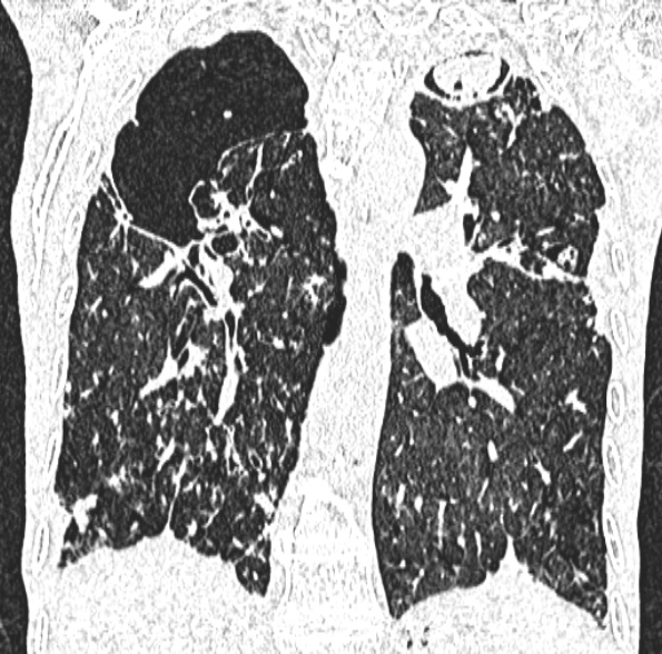 Aspergilloma- with Monod sign (Radiopaedia 44737-48532 Coronal lung window 292).jpg