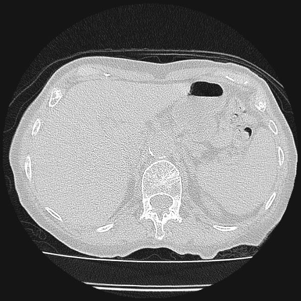 Aspergilloma (Radiopaedia 24458-24763 Axial lung window 69).jpg