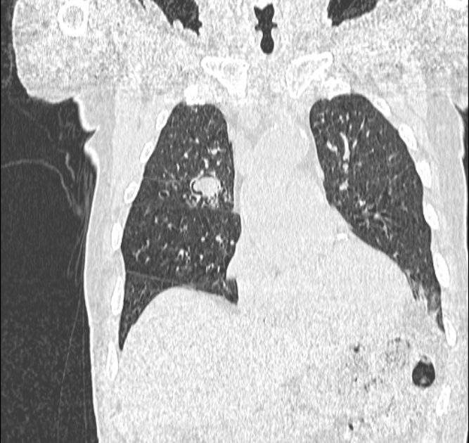 Aspergilloma (Radiopaedia 44592-48327 Coronal lung window 39).jpg